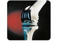 Polishing Compound Removal From Orthopaedic Implants